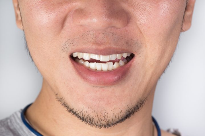 Dislodged Teeth